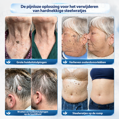 👩‍⚕️𝑺𝒖𝒊𝒊𝒂𝒐® 𝟕-𝐃𝐚𝐠𝐞𝐧 𝐇𝐮𝐢𝐝𝐥𝐢𝐩𝐣𝐞𝐬- & 𝐕𝐥𝐞𝐤𝐤𝐞𝐧𝐯𝐞𝐫𝐰𝐢𝐣𝐝𝐞𝐫𝐢𝐧𝐠𝐬𝐜𝐫è𝐦𝐞 (Pijnloze Formule – Zonder Littekens)☀️