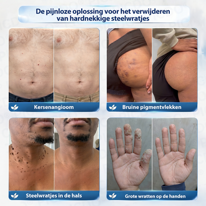 👩‍⚕️𝑺𝒖𝒊𝒊𝒂𝒐® 𝟕-𝐃𝐚𝐠𝐞𝐧 𝐇𝐮𝐢𝐝𝐥𝐢𝐩𝐣𝐞𝐬- & 𝐕𝐥𝐞𝐤𝐤𝐞𝐧𝐯𝐞𝐫𝐰𝐢𝐣𝐝𝐞𝐫𝐢𝐧𝐠𝐬𝐜𝐫è𝐦𝐞 (Pijnloze Formule – Zonder Littekens)☀️