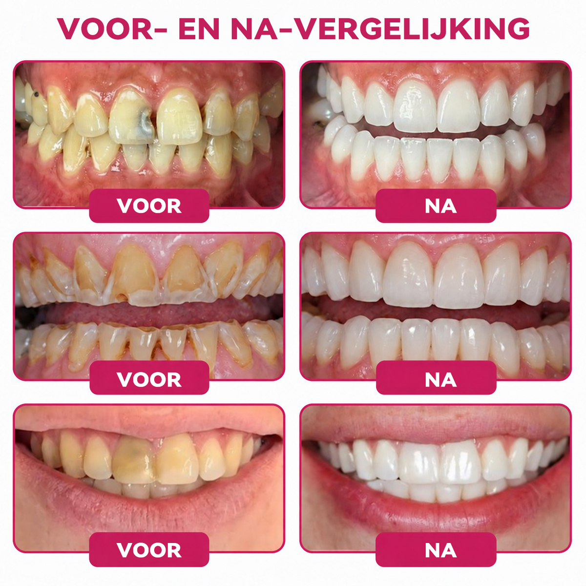 𝑺𝒖𝒊𝒊𝒂𝒐® 🪁DenPerm🎉 —  Gaten Repareren Natuurlijk Glazuur Vulling gel, Gevoelige Tanden en Verzwakt Tandglazuur.