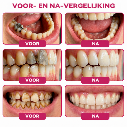 𝑺𝒖𝒊𝒊𝒂𝒐® 🪁DenPerm🎉 —  Gaten Repareren Natuurlijk Glazuur Vulling gel, Gevoelige Tanden en Verzwakt Tandglazuur.