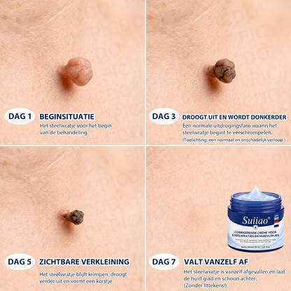 👩‍⚕️𝑺𝒖𝒊𝒊𝒂𝒐® 𝟕-𝐃𝐚𝐠𝐞𝐧 𝐇𝐮𝐢𝐝𝐥𝐢𝐩𝐣𝐞𝐬- & 𝐕𝐥𝐞𝐤𝐤𝐞𝐧𝐯𝐞𝐫𝐰𝐢𝐣𝐝𝐞𝐫𝐢𝐧𝐠𝐬𝐜𝐫è𝐦𝐞 (Pijnloze Formule – Zonder Littekens)☀️